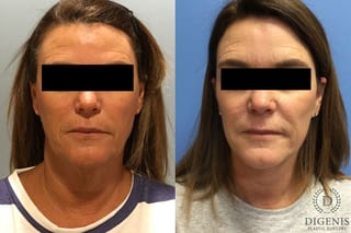 Before and after Face Lift/Neck Lift case 34966 - Angle 1