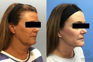Before and after Face Lift/Neck Lift case 34966 - Angle 2