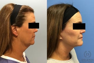 Before and after Face Lift/Neck Lift case 34966 - Angle 3