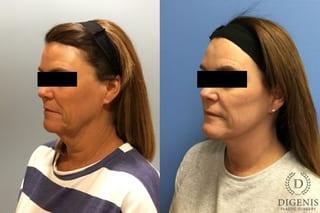 Before and after Face Lift/Neck Lift case 34966 - Angle 4