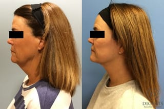 Before and after Face Lift/Neck Lift case 34966 - Angle 5