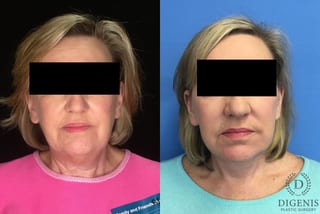 Before and after Face Lift/Neck Lift case 34969 - Angle 1