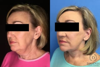 Before and after Face Lift/Neck Lift case 34969 - Angle 2
