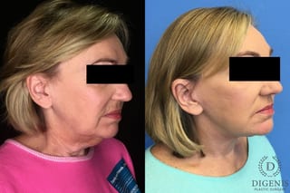 Before and after Face Lift/Neck Lift case 34969 - Angle 4
