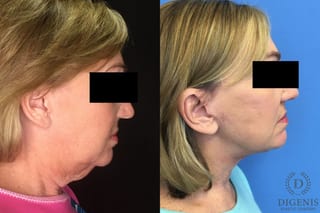 Before and after Face Lift/Neck Lift case 34969 - Angle 5