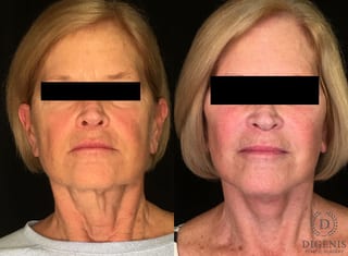 Before and after Face Lift/Neck Lift case 34974 - Angle 1