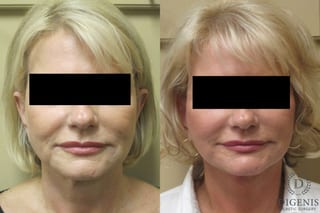 Before and after Face Lift/Neck Lift case 34977 - Angle 1
