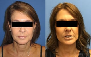 Before and after Face Lift/Neck Lift case 34978 - Angle 1