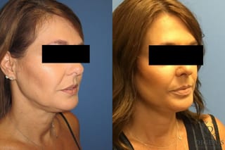 Before and after Face Lift/Neck Lift case 34978 - Angle 2