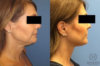 Before and after Face Lift/Neck Lift case 34978 - Angle 3