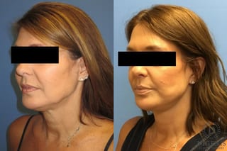 Before and after Face Lift/Neck Lift case 34978 - Angle 4