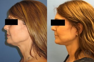 Before and after Face Lift/Neck Lift case 34978 - Angle 5
