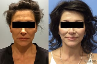 Before and after Face Lift/Neck Lift case 34982 - Angle 1