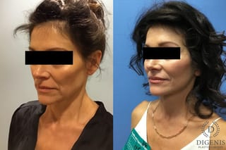 Before and after Face Lift/Neck Lift case 34982 - Angle 2