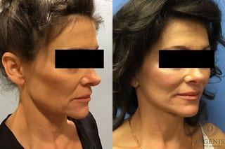 Before and after Face Lift/Neck Lift case 34982 - Angle 4