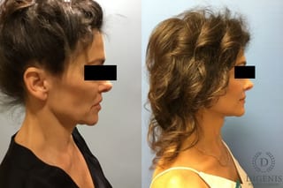Before and after Face Lift/Neck Lift case 34982 - Angle 5