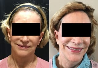 Before and after Face Lift/Neck Lift case 34985 - Angle 1