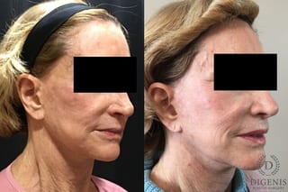 Before and after Face Lift/Neck Lift case 34985 - Angle 2