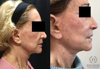 Before and after Face Lift/Neck Lift case 34985 - Angle 3