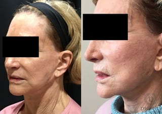 Before and after Face Lift/Neck Lift case 34985 - Angle 4