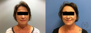 Before and after Face Lift/Neck Lift case 34987 - Angle 1