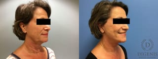 Before and after Face Lift/Neck Lift case 34987 - Angle 2