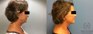 Before and after Face Lift/Neck Lift case 34987 - Angle 3