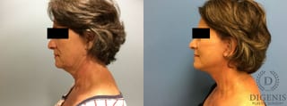 Before and after Face Lift/Neck Lift case 34987 - Angle 5