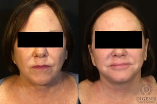 Before and after Face Lift/Neck Lift case 34989 - Angle 1