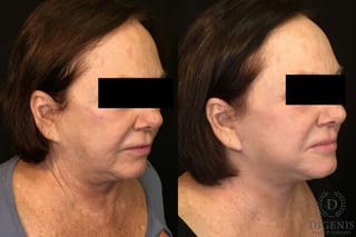 Before and after Face Lift/Neck Lift case 34989 - Angle 2