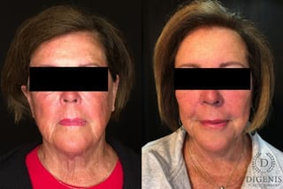 Before and after Face Lift/Neck Lift case 34991 - Angle 1