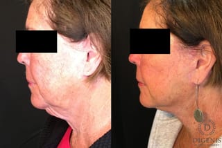 Before and after Face Lift/Neck Lift case 34991 - Angle 5