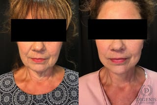 Before and after Face Lift/Neck Lift case 34992 - Angle 1