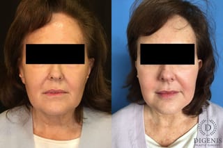 Before and after Face Lift/Neck Lift case 34993 - Angle 1
