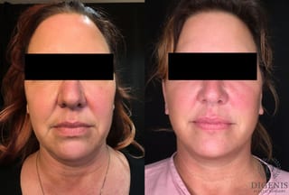 Before and after Face Lift/Neck Lift case 34994 - Angle 1