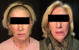 Before and after Face Lift/Neck Lift case 34996 - Angle 1