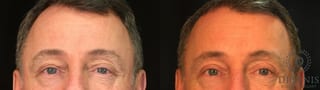Before and after Eye Lid Surgery case 35029 - Angle 1