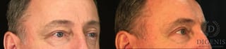 Before and after Eye Lid Surgery case 35029 - Angle 2