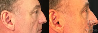 Before and after Eye Lid Surgery case 35029 - Angle 3