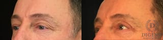 Before and after Eye Lid Surgery case 35029 - Angle 4