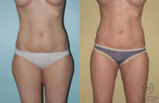 Before and after Liposuction case 35039 - Angle 1