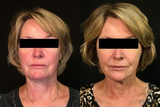 Before and after Digenis Refresh Lift case 35048 - Angle 1