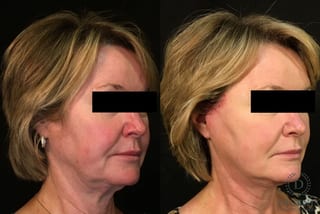 Before and after Digenis Refresh Lift case 35048 - Angle 2