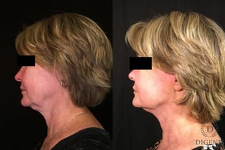 Before and after Digenis Refresh Lift case 35048 - Angle 5