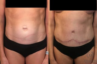 Before and after Tummy Tuck case 35052 - Angle 1