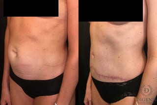 Before and after Tummy Tuck case 35052 - Angle 4