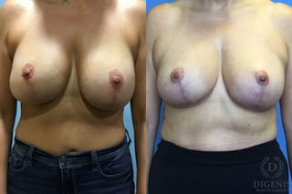 Before and after Breast Lift with or without Implants case 35058 - Angle 1