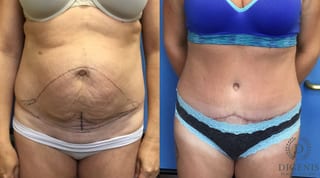 Before and after Tummy Tuck case 35060 - Angle 1