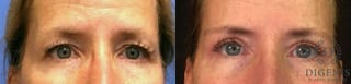 Before and after Eye Lid Surgery case 35059 - Angle 1