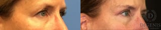 Before and after Eye Lid Surgery case 35059 - Angle 2